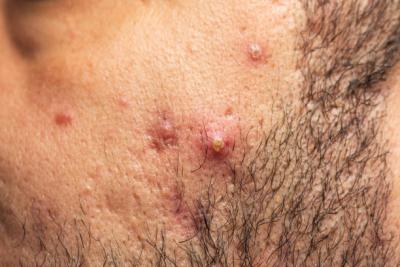 The Most Common Causes Of Acne In Men